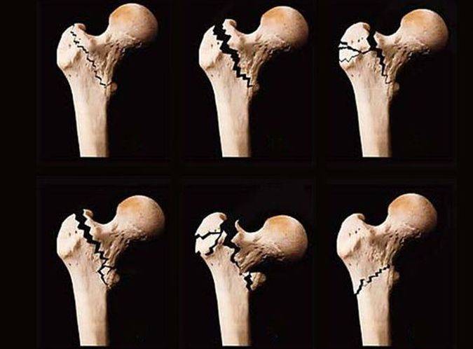素朴中医院通血生骨方:股骨头坏死不可怕,这点最重要!