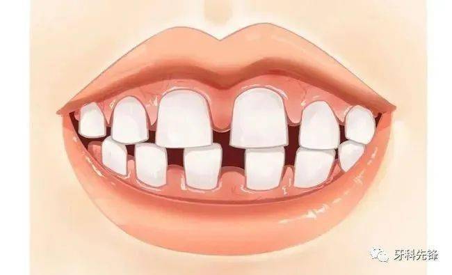 吃东西老塞牙？海斯口腔郑峰提醒您：很有可能是牙齿疾病