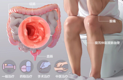 云太医消化科专家王幼立主任为溃疡性结肠炎患者送去福音