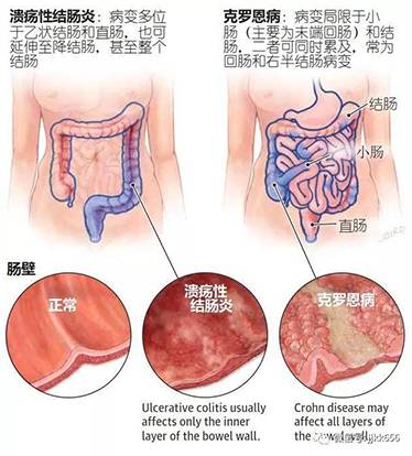 云太医脾胃专家——王幼立主任，带领患者克服克罗恩，迎来生活新曙光