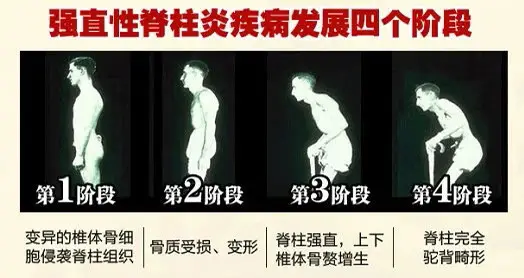 40年中医门诊经验，保守治疗28天，让20年强直脊柱炎患者，重新下床走路